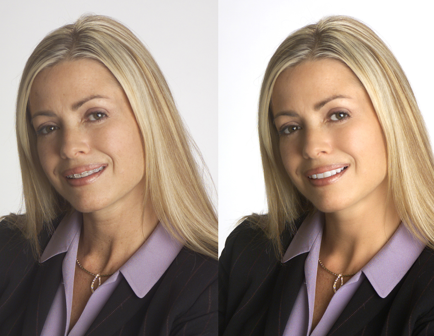 before and after photo retouch to remove dental braces